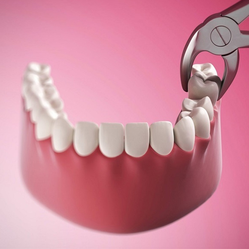 Kỹ thuật nhổ răng ảnh hưởng đến kết quả hình thành lỗ