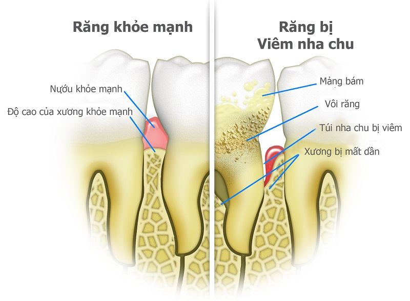 Viêm nha chu mãn tính hình thành do vi khuẩn ở mảng bám chân răng gây viêm nhiễm