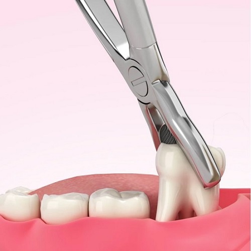 Việc nhổ răng khôn bao lâu thì lành còn tùy thuộc vào cơ địa của người bệnh