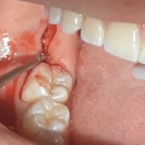 Nhổ răng khôn bị chảy máu là hiện tượng thông thường