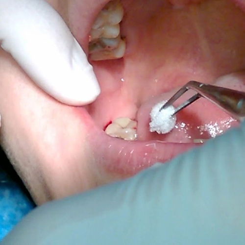 Rất nhiều người bệnh thắc mắc rằng nhổ răng khôn chảy máu bao lâu