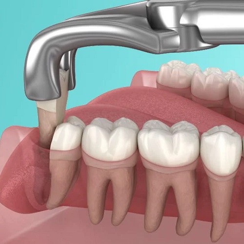Nhổ răng khôn có đau không còn phụ thuộc vào nhiều yếu tố