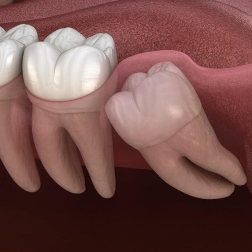 Răng khô hàm dưới mọc ngầm hoặc mọc lệch buộc phải nhổ bỏ 