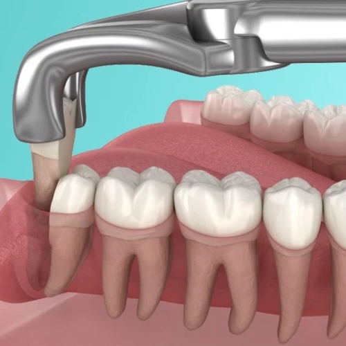 Kỹ thuật nhổ răng khôn hàm dưới phải được thực hiện theo đúng quy trình gồm 4 bước 