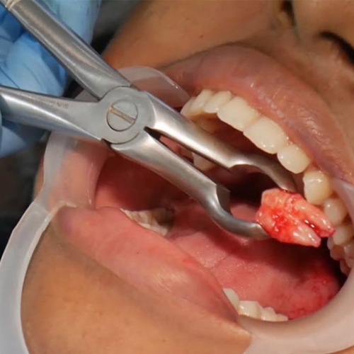 Các chuyên gia nhận định, nhổ răng khô hàm dưới khó hơn so với hàm trên 