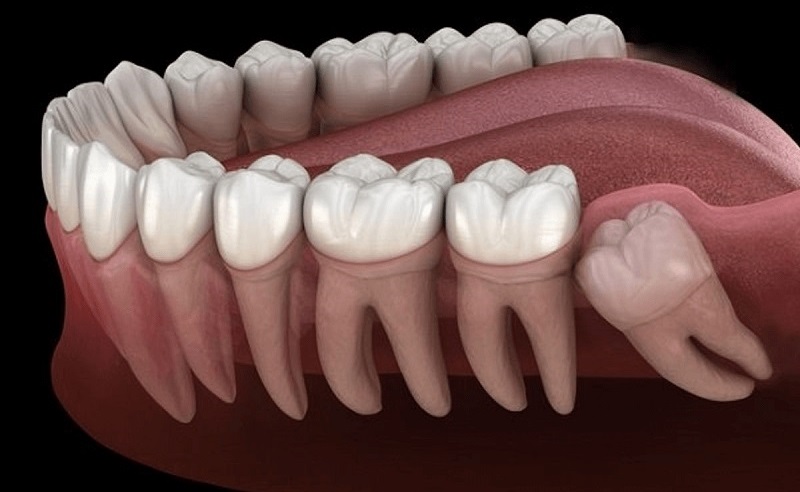 Răng khôn mọc lệch là tình trạng khá phổ biến