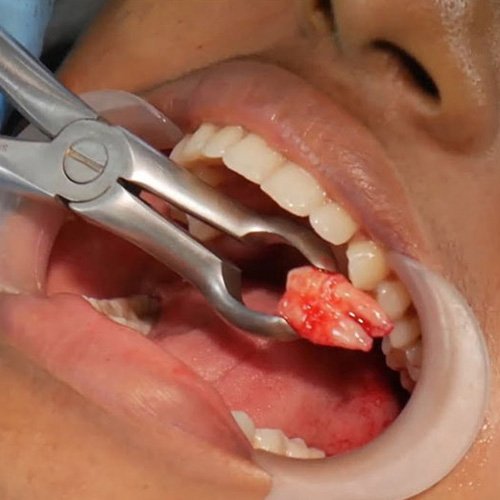 Ca nhổ răng có khó không còn phụ thuộc vào tình trạng răng cụ thể