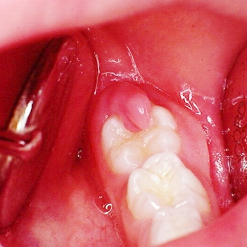 Nhổ răng khôn sưng trong bao lâu phụ thuộc vào từng trường hợp điều trị