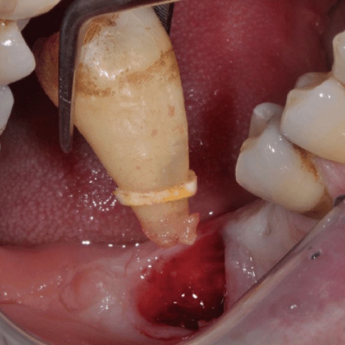 Nho răng số 7 có nguy hiểm không phụ thuộc vào tay nghề của nha sĩ