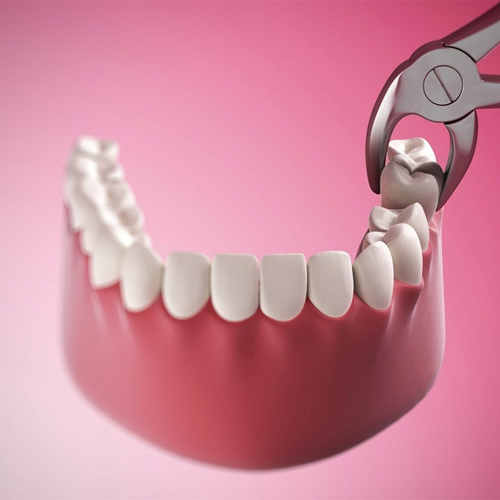 Các nha sĩ khẳng định nhổ răng số 8 không gây nguy hiểm