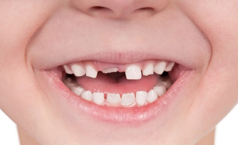 Răng vĩnh viễn có thể sẽ mọc lên bình thường đào thải chân răng sữa của bé.