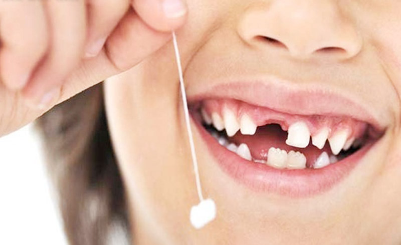 Nhổ răng sữa lung lay bằng chỉ là cách làm thông dụng được nhiều phụ huynh sử dụng.