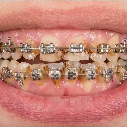 Niềng răng bị tụt lợi do bệnh nha chu từ trước 