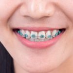 Niềng răng bị tụt lợi làm răng nhạy nhảy cảm và tăng nguy cơ mất răng vĩnh viễn