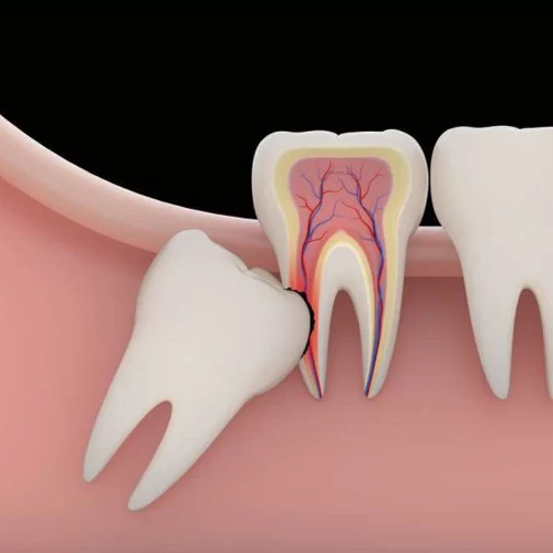 Nhổ răng khôn mọc bất thường giúp đảm bảo sức khỏe răng miệng