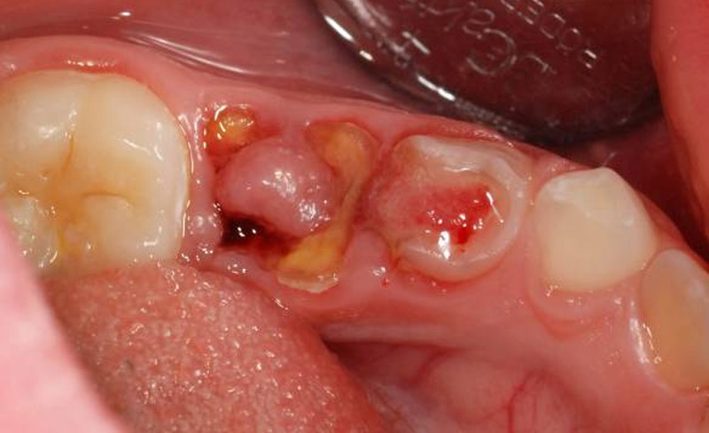 Răng sâu lồi thịt chảy máu gây ảnh hưởng không nhỏ tới sinh hoạt của người bệnh.