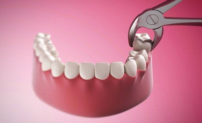 Cách xử lý răng số 8 bị sâu vỡ là nhổ bỏ răng