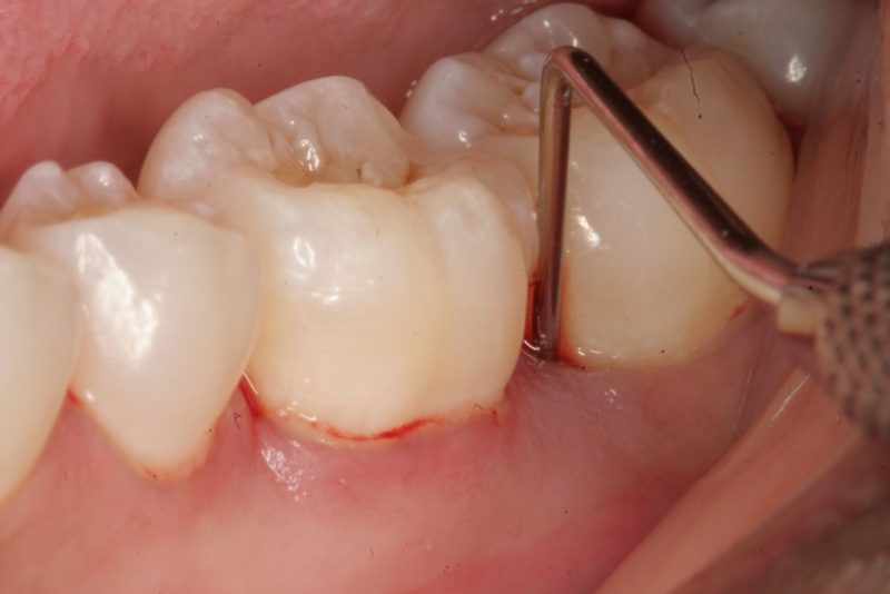 Phân biệt sâu khe răng và sâu trong răng – Cách điều trị dứt điểm