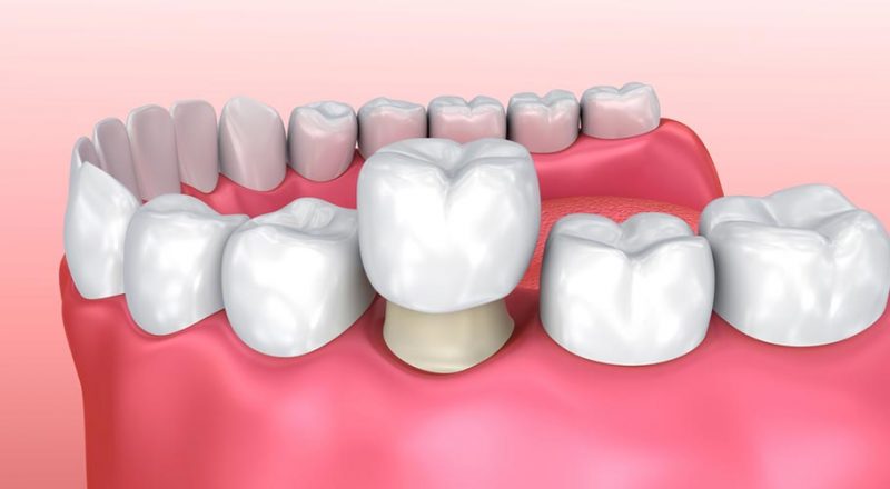 Điều trị sâu kẽ răng bằng biện pháp bọc răng sứ