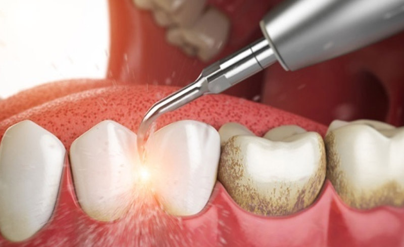 Nên lấy cao răng định kỳ 6 tháng 1 lần để có hàm răng sạch khỏe.