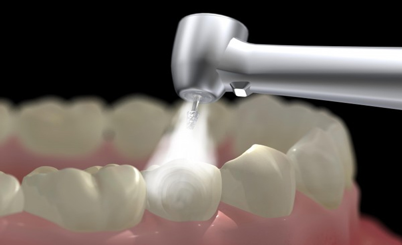 Trám răng là phương pháp trị sâu răng phổ biến hiện nay với hiệu quả cao.