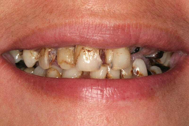 Sâu răng cửa: Nhận biết, nguyên nhân và hướng xử lý thích hợp