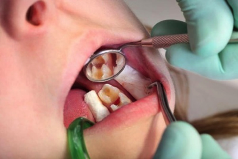 Viêm tủy răng hàm cùng nhiều biến chứng khác là hệ quả nặng nề của sâu răng hàm ở người lớn
