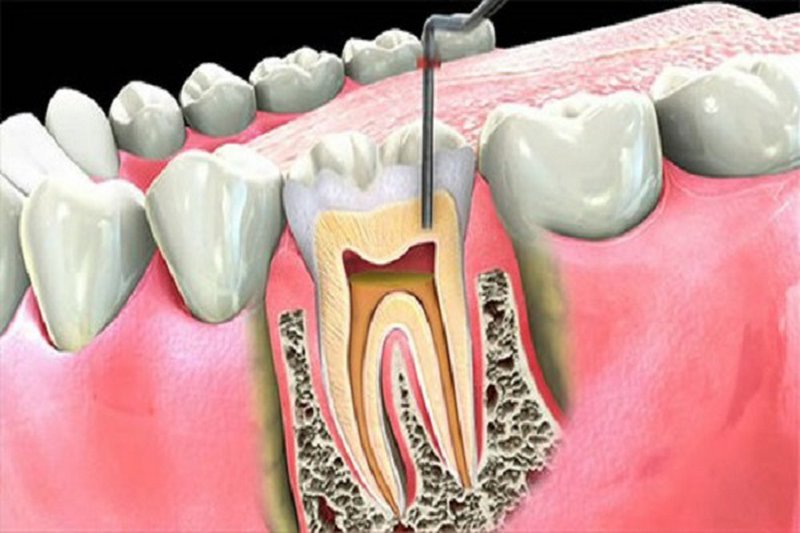 Điều trị sâu răng hàm bằng biện pháp điều trị tủy, bọc răng sứ
