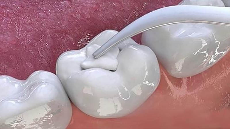 Trám răng là biện pháp khắc phục phổ biến nhất
