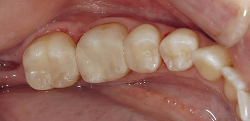 Sâu răng nhẹ có nguy hiểm không? Cách khắc phục kịp thời