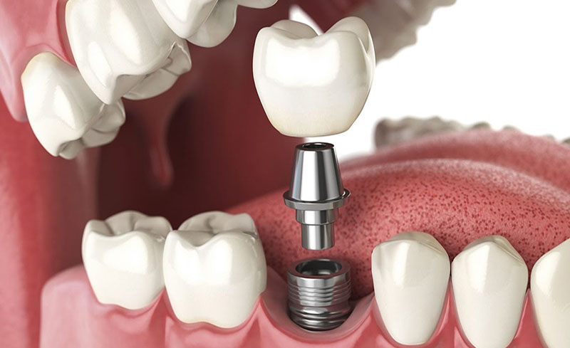Khôi phục răng số 5 bằng phương pháp cấy ghép Implant.