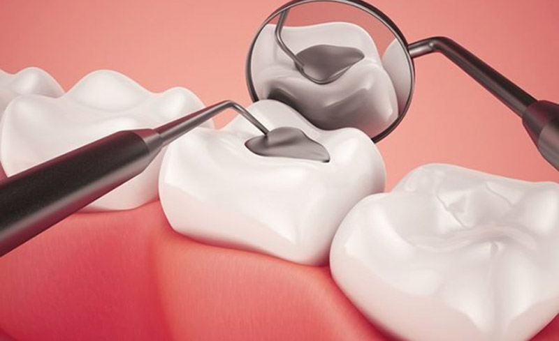 Bị sâu răng số 6 hàm dưới nhẹ cần trám răng để bảo vệ.
