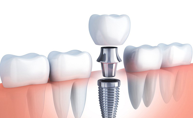 Sâu răng số 6 hàm trên hoặc dưới quá nặng phải nhổ bỏ và thay thế bằng phương pháp trồng răng Implant