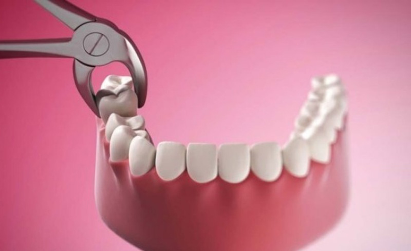 Nhổ sâu răng số 7 hư hại để bảo vệ các răng khác.