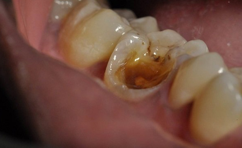  Hình ảnh người bệnh bị sâu răng số 7 hàm dưới