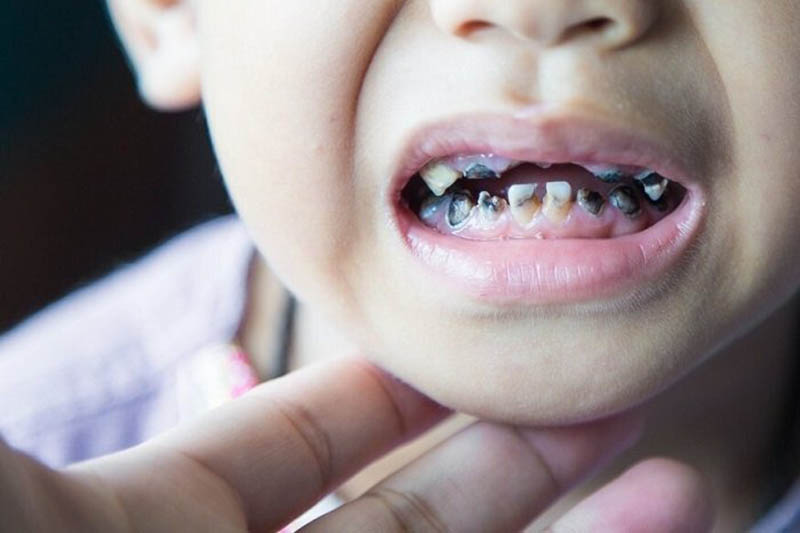 Cách điều trị tại nha khoa đối với hình ảnh sâu răng trẻ em