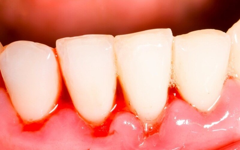 Đây là một trong những biểu hiện về những bệnh lý răng miệng và chăm sóc răng không đúng cách