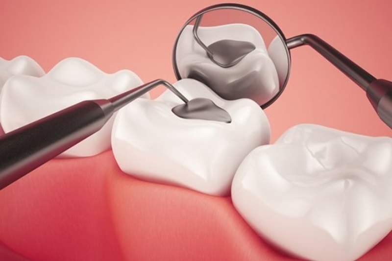 Tại nha khoa các bác sĩ sẽ sử dụng phương pháp trám răng cho người bệnh