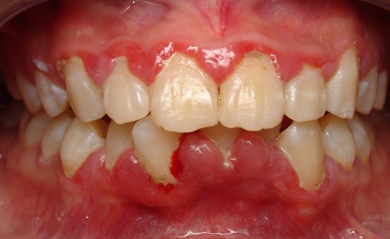Sưng nướu răng có mủ chỉ tình trạng nhiễm trùng ở các mô gây hình thành ổ mủ