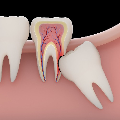 Răng khôn sẽ gây ảnh hưởng tới răng số 7