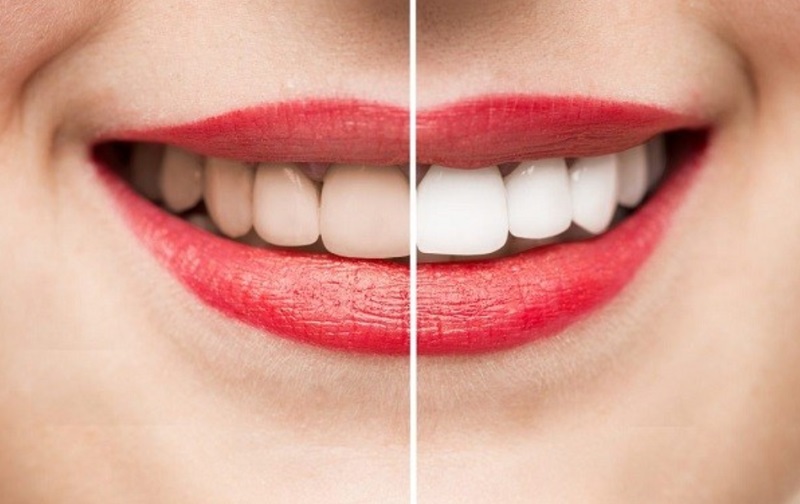 Tẩy trắng răng là phương pháp thẩm mỹ nha khoa phổ biến hiện nay