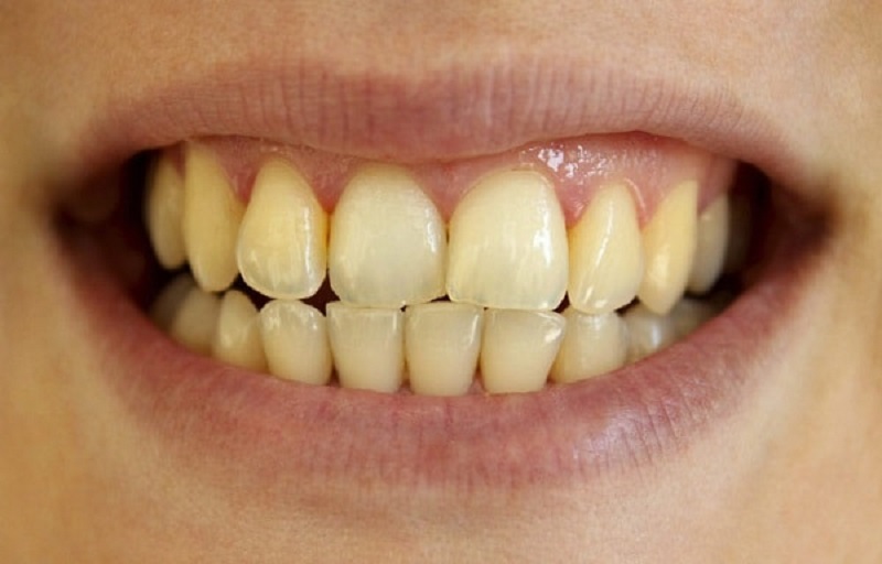 Đối tượng có men răng bị ố vàng nên thực hiện làm trắng răng