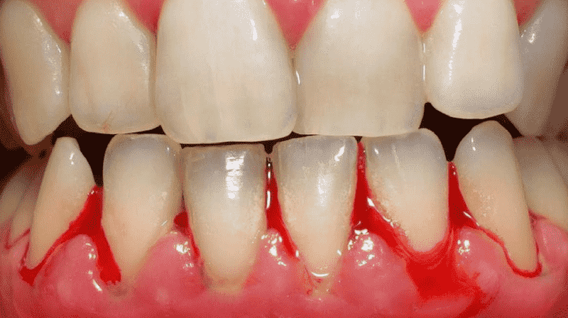 Thức ăn cứng có ảnh hưởng đến chảy máu chân răng không? 
