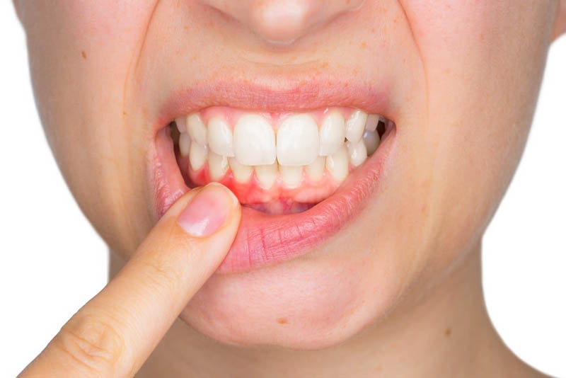 Người bị viêm nướu có thể bị ảnh hưởng nghiêm trọng về sức khỏe răng miệng