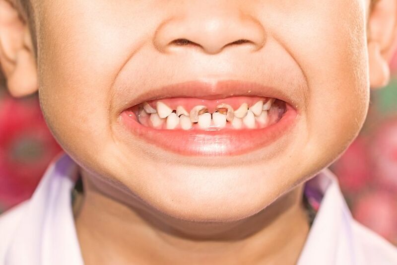 Nguyên nhân dẫn đến tình trạng trẻ bị sâu răng sữa