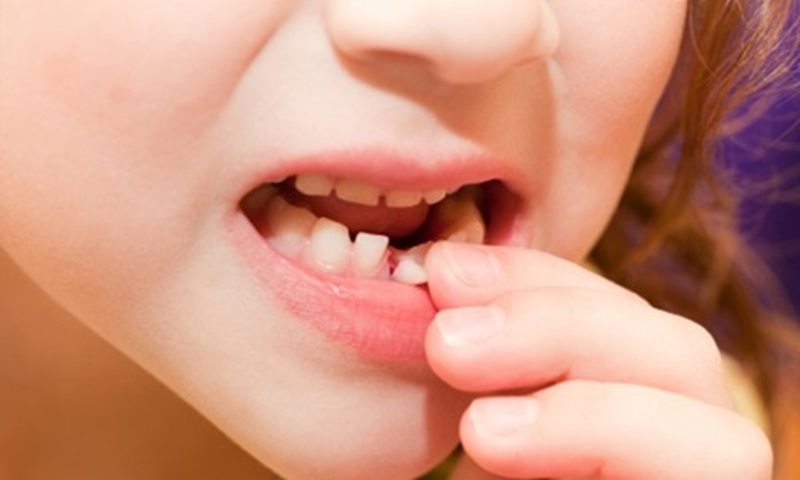 Do cấu trúc răng của trẻ khiến việc nhổ răng sữa lâu mọc diễn ra ở trẻ
