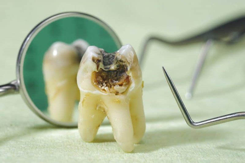 Tổng hợp các phương pháp điều trị sâu răng tận gốc