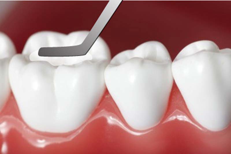 Tái khoáng giúp cho men răng chắc khoẻ hơn, từ đó khắc phục được bệnh