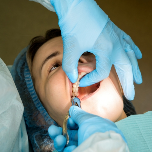 Nhổ bỏ răng khôn để bảo vệ sức khỏe răng miệng