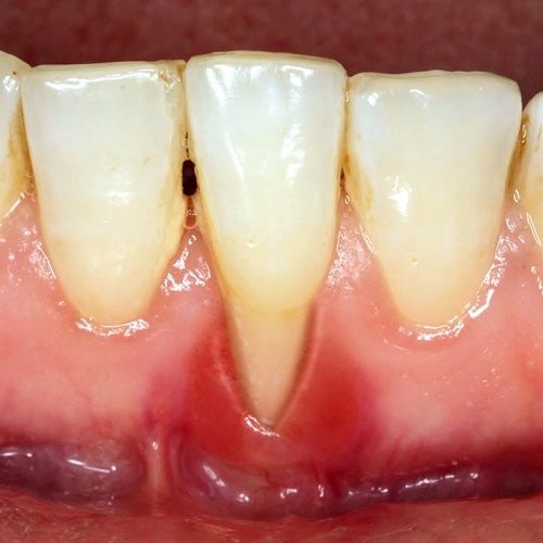 Tụt lợi chảy máu chân răng là tình trạng phần lợi dần di chuyển xuống dưới